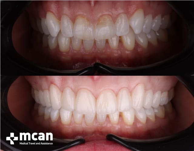 Antes y después de las Carillas de porcelana 5 | MCAN Health