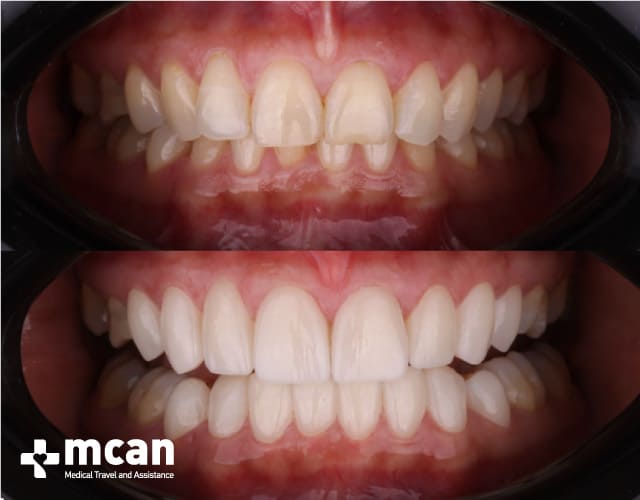 Antes y después de las Carillas de porcelana 8 | MCAN Health