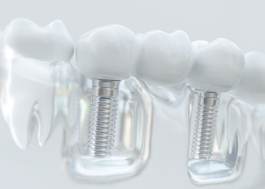 Implantes dentales completos