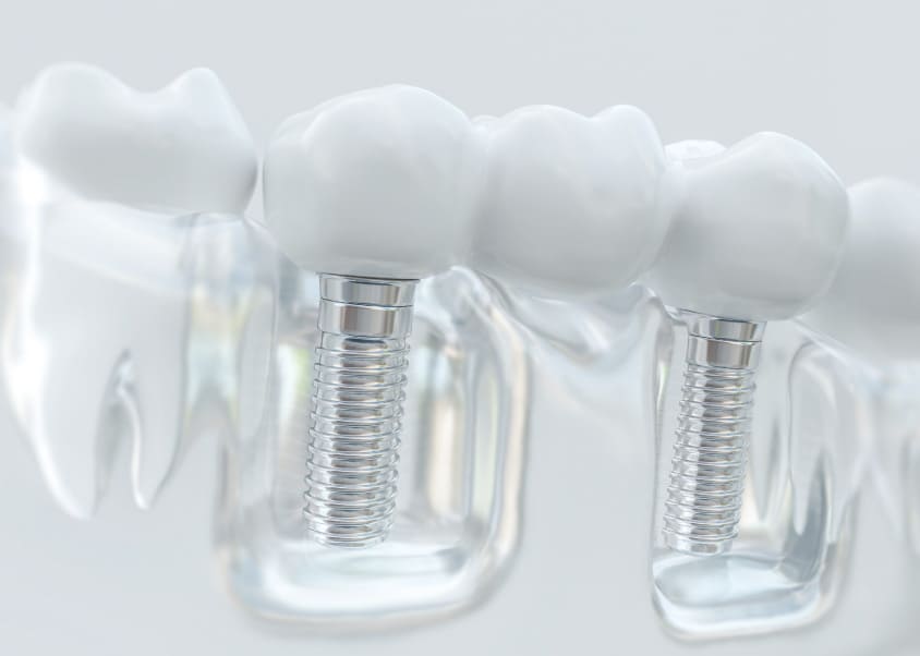 /Volles Implantat vs. All on 4 Implantat