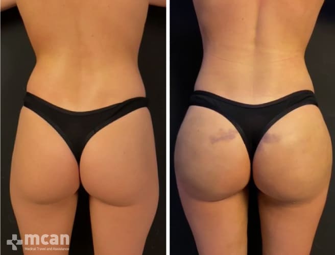 Brazilian Butt Lift before and after in Turkey