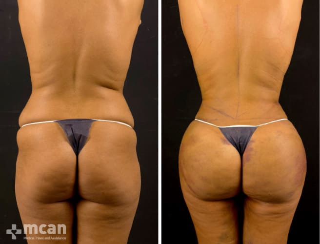Brazilian Butt Lift before and after the procedure
