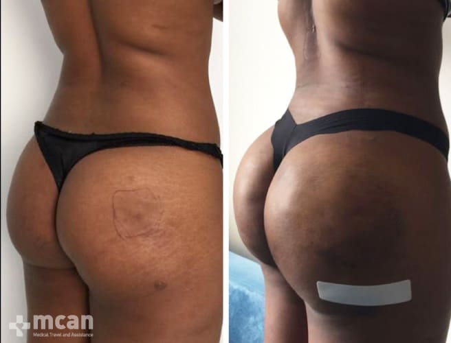 Brazilian Butt Lift surgery in Turkey