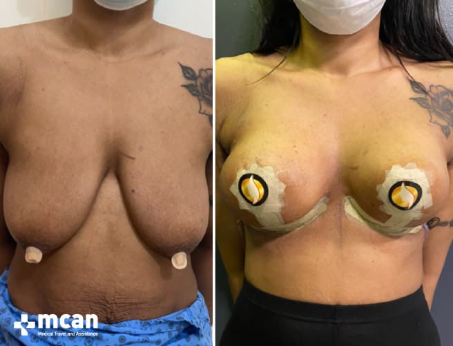 Breast lift before the procedure