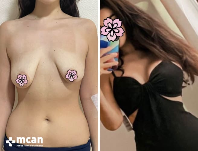 Breast lift and implants