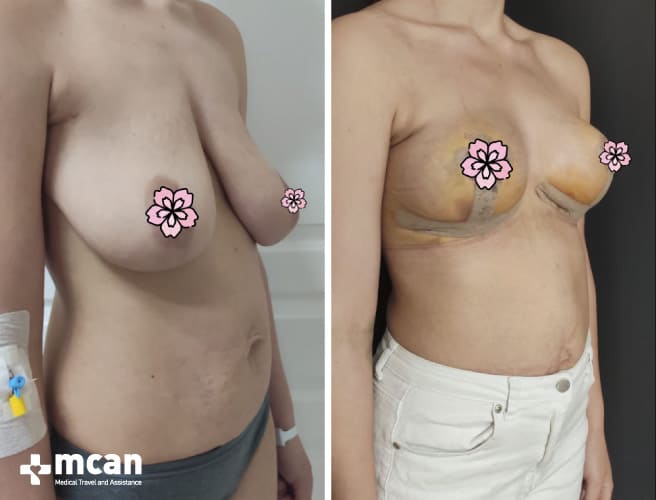 Breast Lift Before After 8