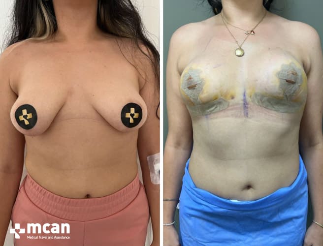 Breast Lift Before After 9