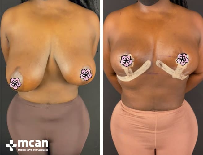 Breast reduction Turkey before and after