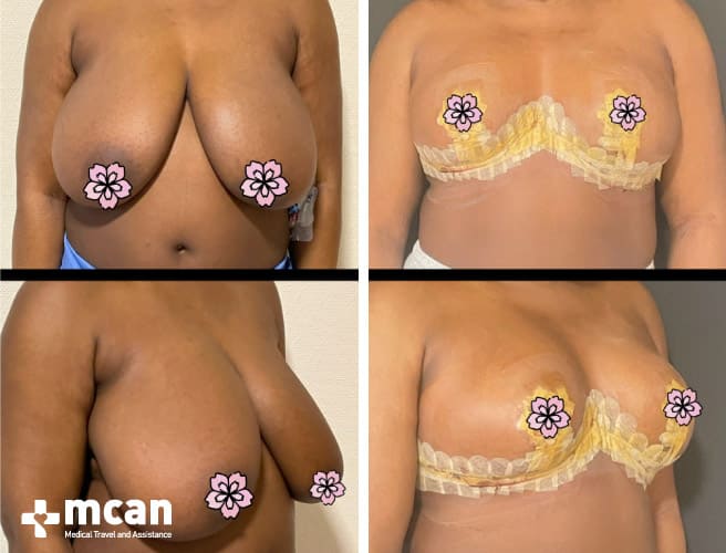Breast reduction cosmetic procedure