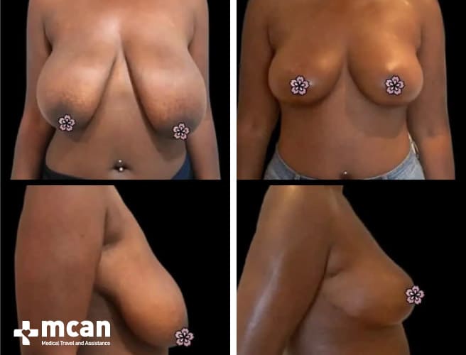 Breast reduction remarkable results