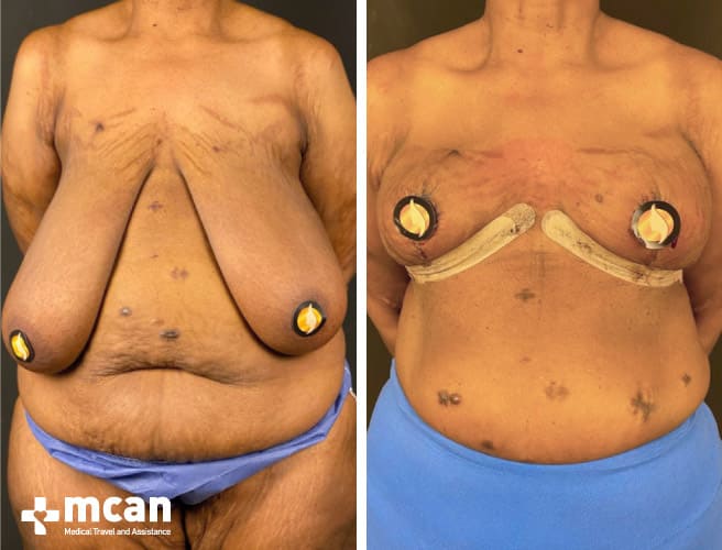 before and after the breast reduction surgery