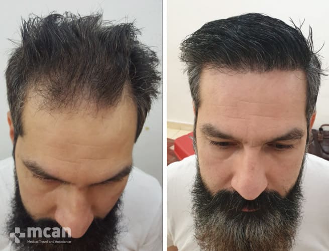 Sapphire FUE hair transplant before and after