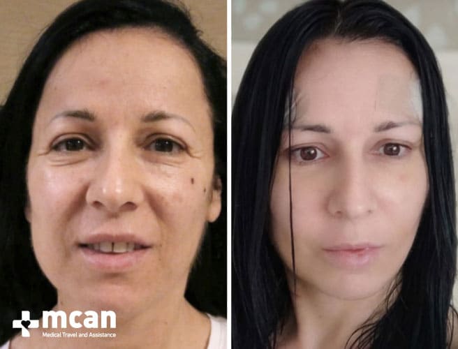 Gesamter Facelift  Türkei