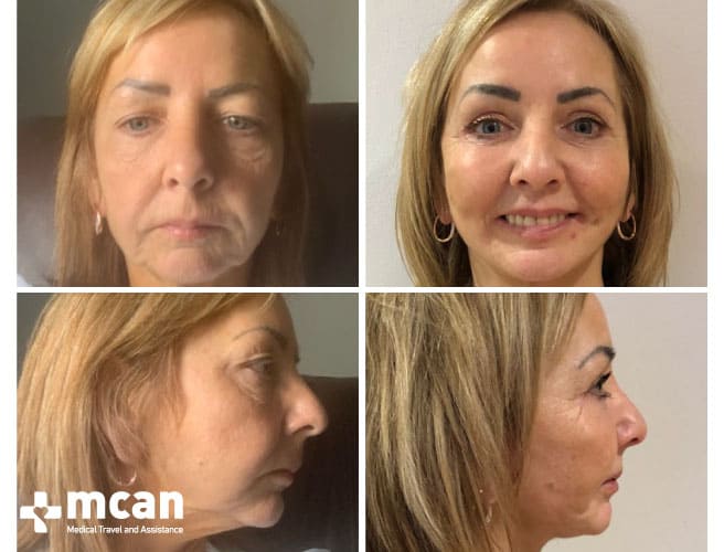 Facelift Before After 10