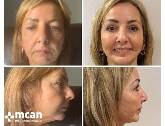 Rejuvenation with facelift