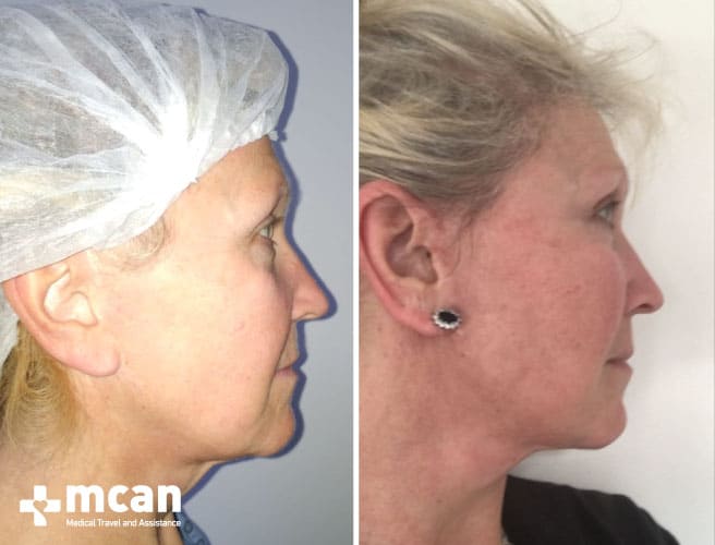 Inspirational facelift results