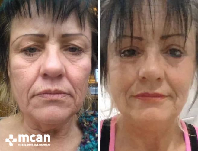 facelift process Turkey