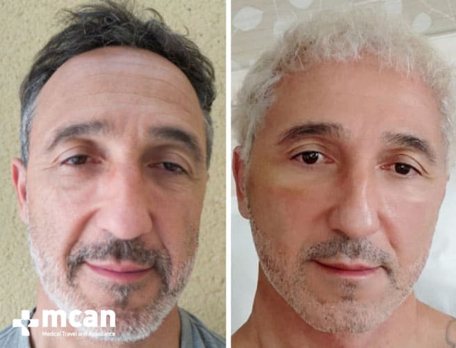 Lifting Facial Antes y Después 2