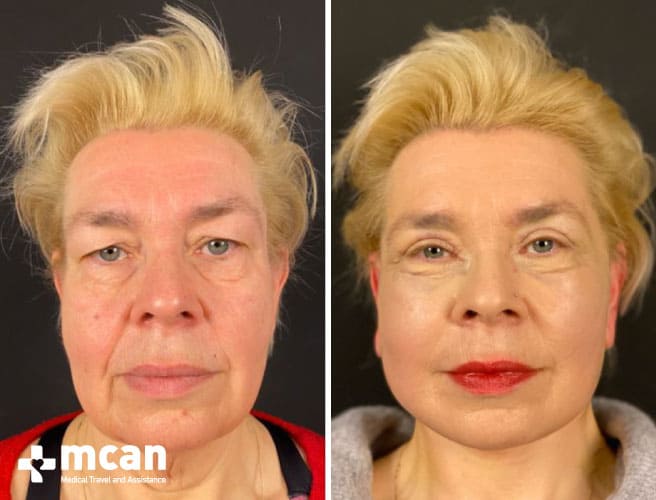 Beste Facelift Ergebnisse