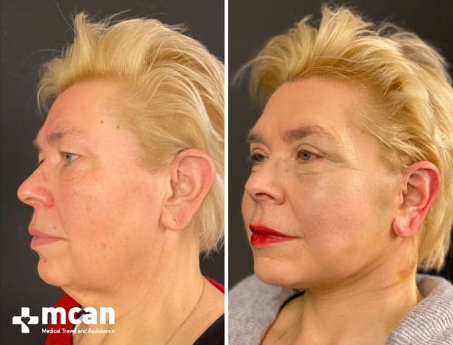 Facelift Nachher Seiten