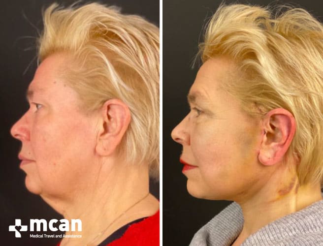 Facelift vorher nachher Narben