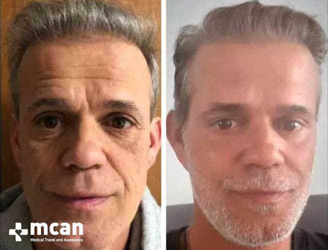 Lifting Facial Antes y Después 6