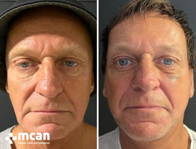 Lifting Facial Antes y Después 8