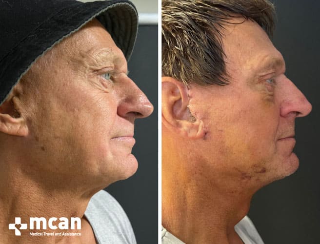 Facelift Before After 9