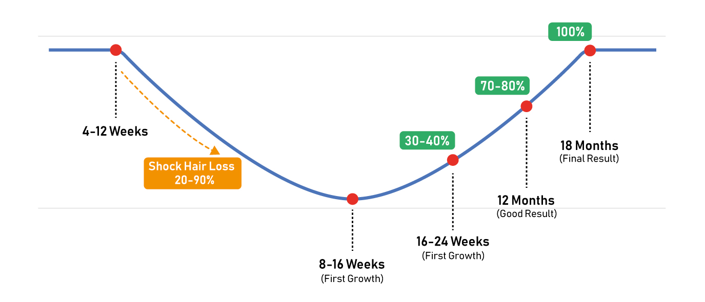 Hair Transplant Recovery in 18-Months 3 Hair Growth Table 1 Hair transplant recovery timeline