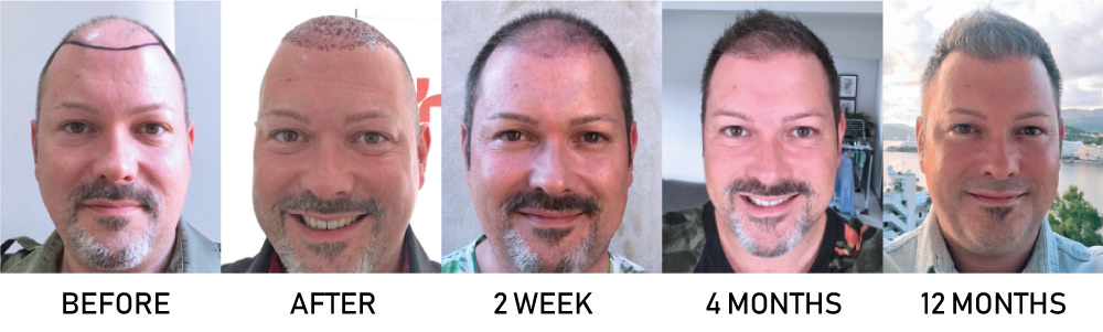 Hair Transplant Recovery in 18-Months