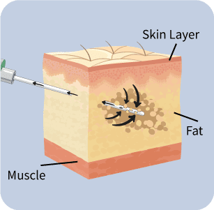 Tumescent Liposuction
