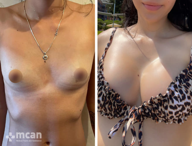 Breast Enlargement Before After 1