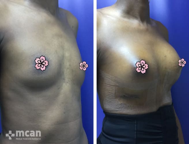 Breast Enlargement Before After 11
