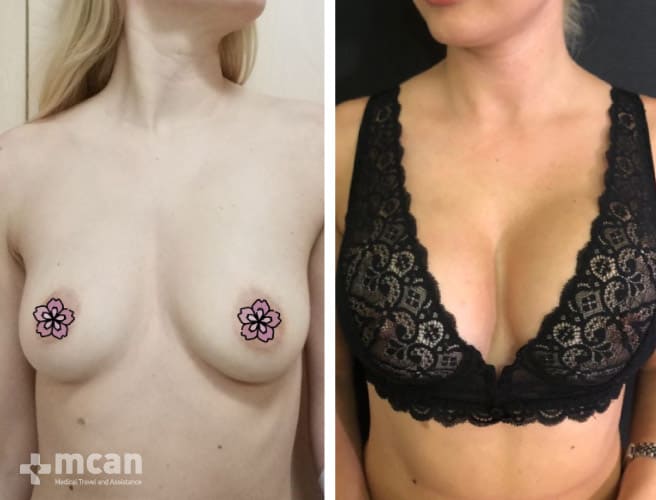 Breast Enlargement Before After 6