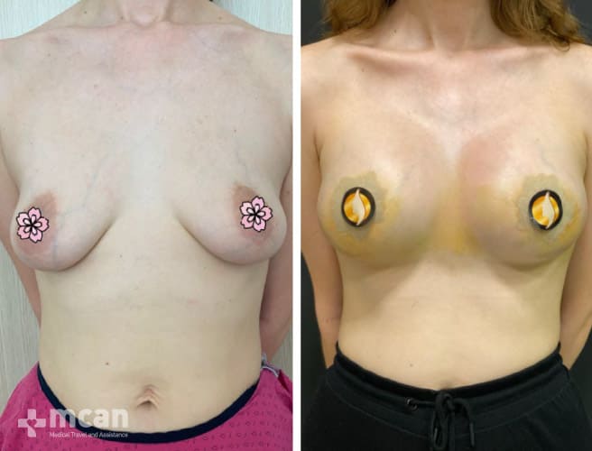 Breast Enlargement Before After 8