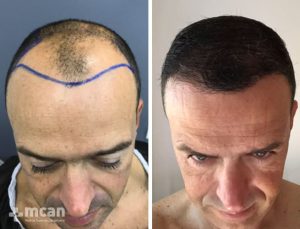FUE hair transplant in Turkey Before After 11