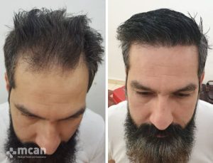 FUE hair transplant in Turkey Before After 14