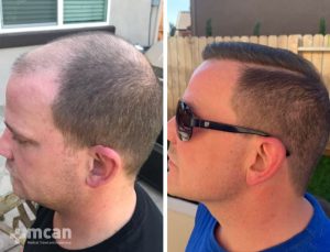 FUE hair transplant in Turkey Before After 15