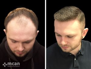 FUE hair transplant in Turkey Before After 16