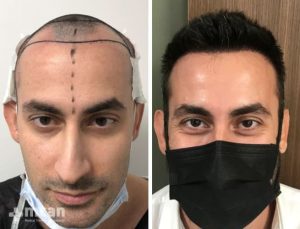 FUE hair transplant in Turkey Before After 18