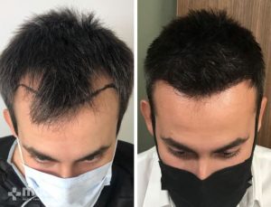 FUE hair transplant in Turkey Before After 19