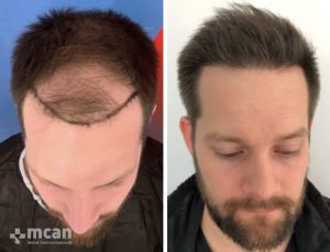 FUE hair transplant in Turkey Before After 20