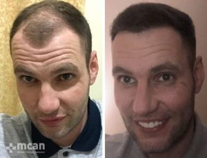 FUE hair transplant in Turkey Before After 21