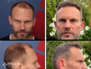 FUE hair transplant in Turkey Before After 22