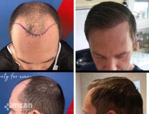 FUE hair transplant in Turkey Before After 23