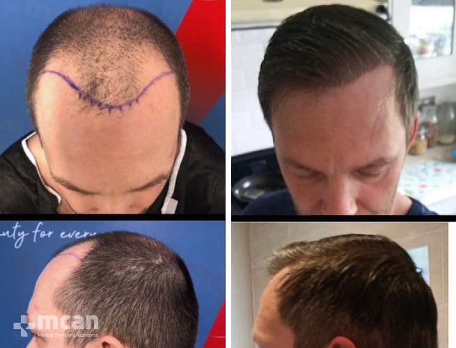 4500 Hair follicle transplant with FUE