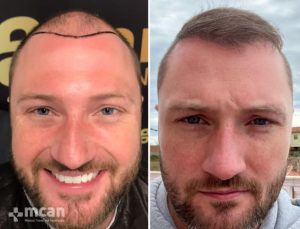 FUE hair transplant in Turkey Before After 26