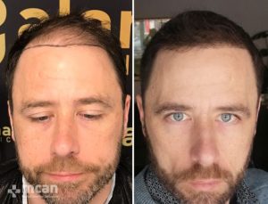 FUE hair transplant in Turkey Before After 27
