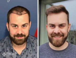 FUE hair transplant in Turkey Before After 3