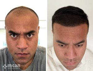 FUE hair transplant in Turkey Before After 6